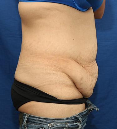 Before Results for Panniculectomy