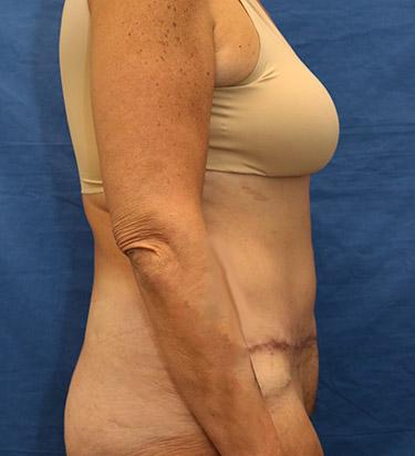 After Results for Panniculectomy