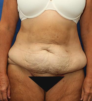 Before Results for Panniculectomy