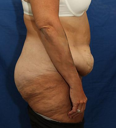 Before Results for Panniculectomy