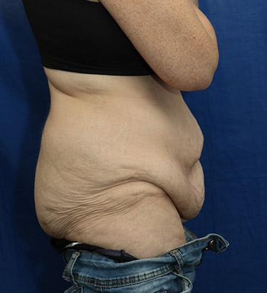 Before Results for Panniculectomy