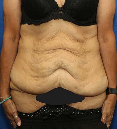 Before Results for Panniculectomy