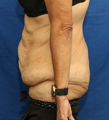 Before Results for Panniculectomy