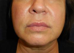 Before Results for Neuromodulators (Botox / Dysport), Tissue Fillers, Lip Augmentation
