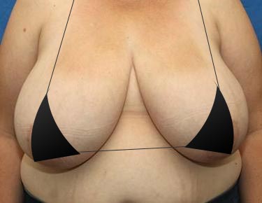 Breast Reduction - Elite Plastic & Reconstructive Surgery